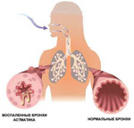 Народные способы лечения астмы